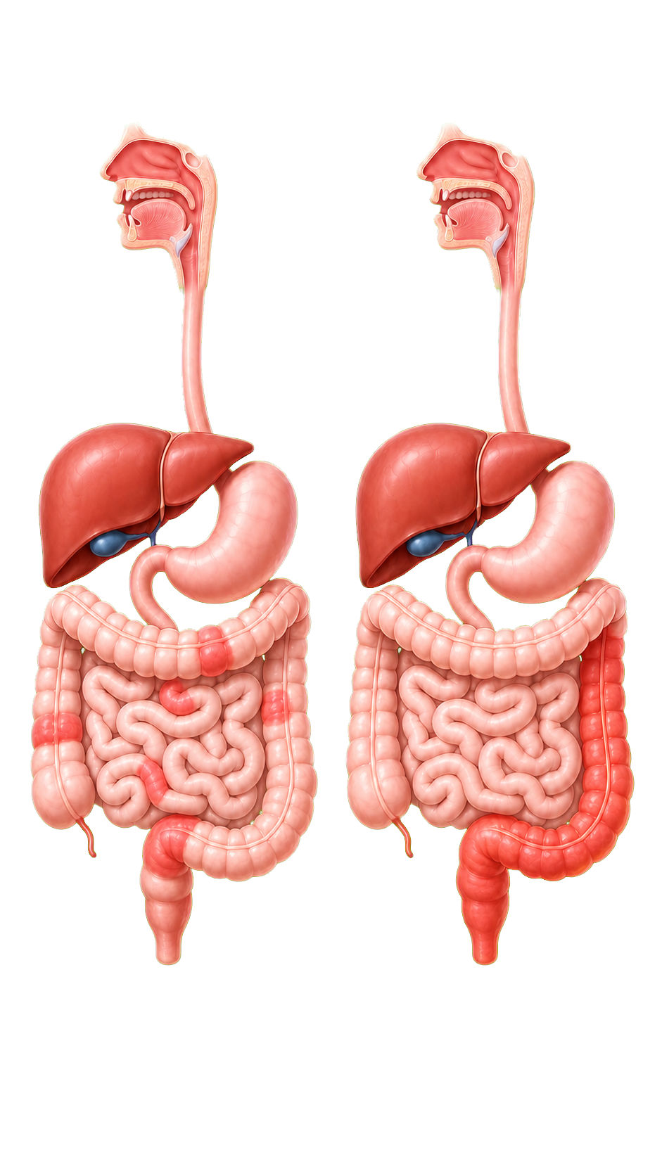 Direkter Vergleich der Ausbreitung von Morbus Crohn und Colitis ulcerosa