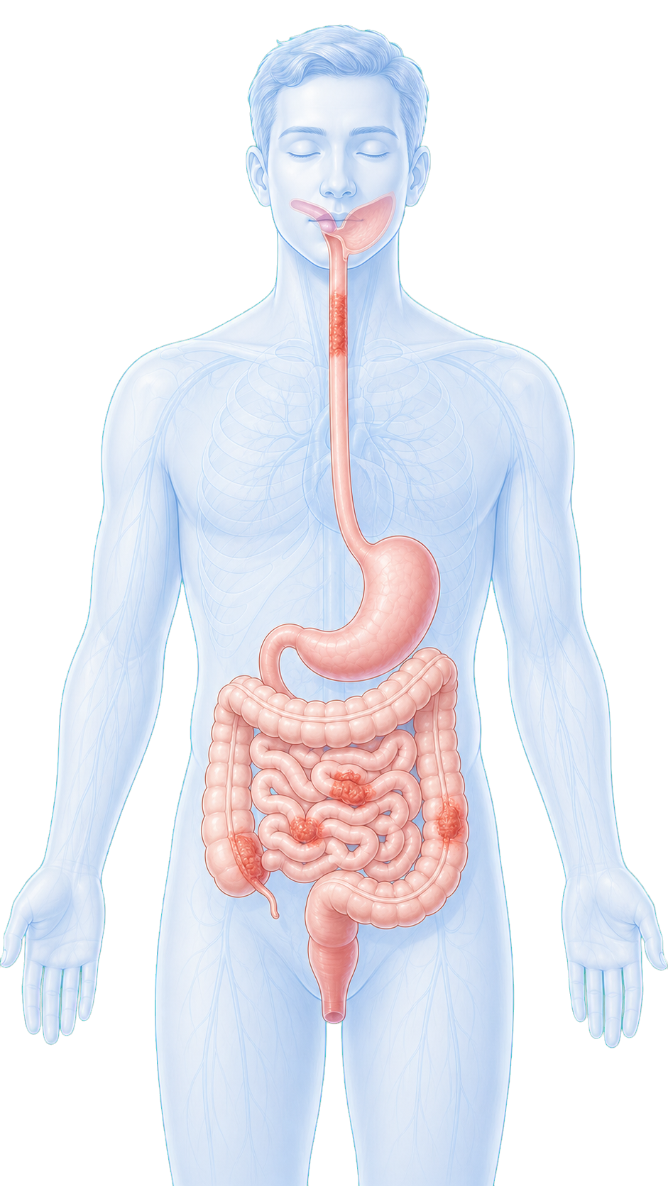 Gesamter Verdauungstrakt mit möglichen Bereichen eines Morbus Crohn