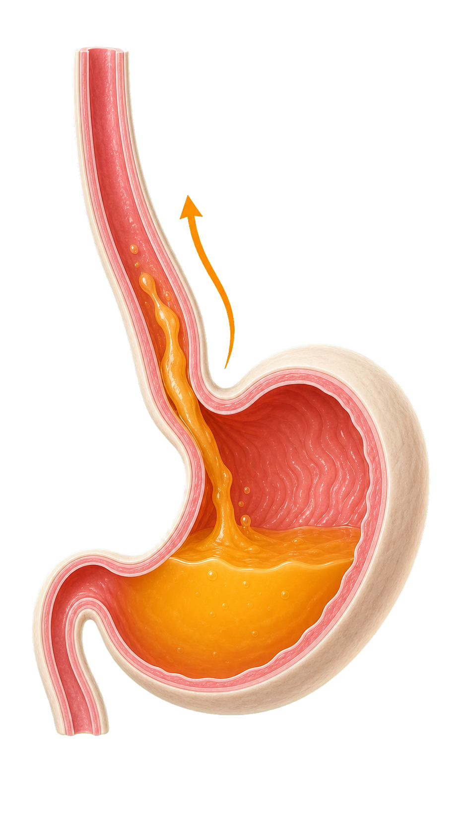 Medizinische Illustration von Speiseröhre und Magen mit aufsteigendem Mageninhalt