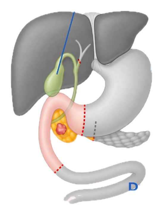 Häufiger Anlass ist ein Tumor im Bereich des Bauchspeicheldrüsenkopfes.